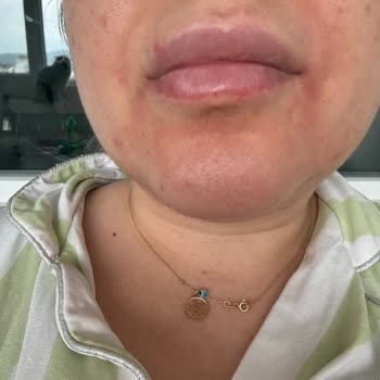 Madecassol Kremi Ciltte Şiddetli Yanma Ve Kuruluk Yarattı