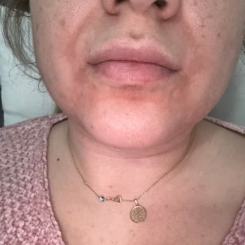 Madecassol Kremi Ciltte Şiddetli Yanma Ve Kuruluk Yarattı