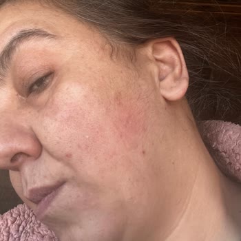 Bioderma Ürünü Alerjik Reaksiyon Ve Eczane İlgisizliği