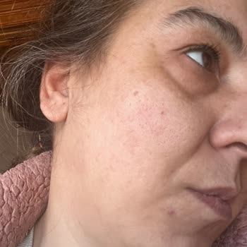 Bioderma Ürünü Alerjik Reaksiyon Ve Eczane İlgisizliği