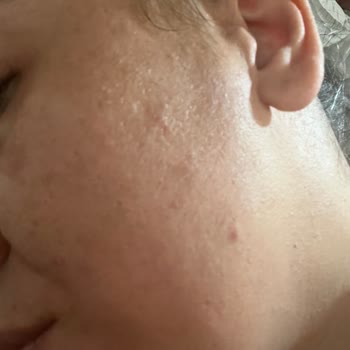 Bioderma Ürünü Alerjik Reaksiyon Ve Eczane İlgisizliği