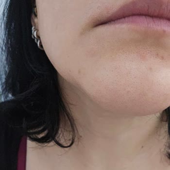 Pure Beauty Kremi Ciltte Aknelere Ve Tahrişe Neden Oldu İade Talebi