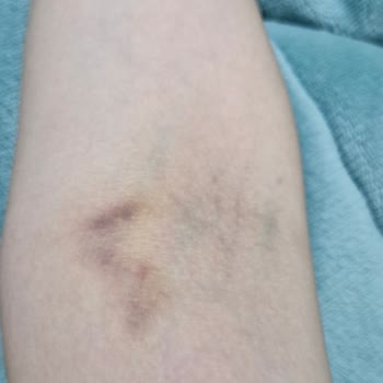 Merkez Prime Hastanesi | Gebze Damar Yolu Açımında Hata