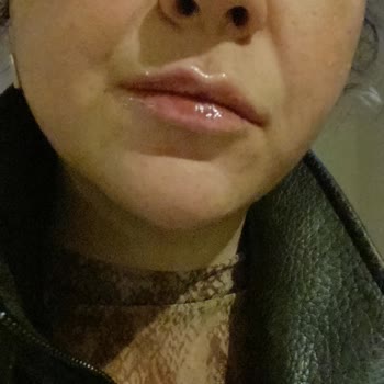 Maya Estetik Dolgu Miktarı Yanıltması ve Haksız Satış