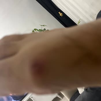 Ayakkabının İç Dikişleri Yara Yaptı İade Ve Değişim İstiyorum