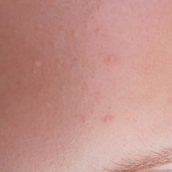 Garnier C Vitamini Ürünün Kızımda Oluşturduğu Sivilceler Ve Psikolojik Mağduriyet