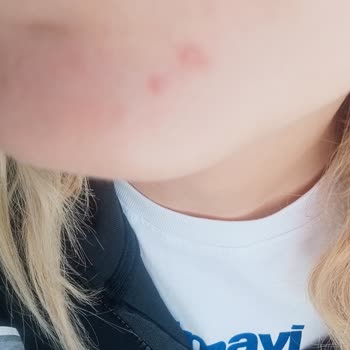 Garnier C Vitamini Ürünün Kızımda Oluşturduğu Sivilceler Ve Psikolojik Mağduriyet