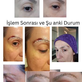 Sınırsız Kaş Silme Paketi İptali Ve Kalıcı Yanıklar Nedeniyle Fiziksel Ve Maddi Mağduriyet