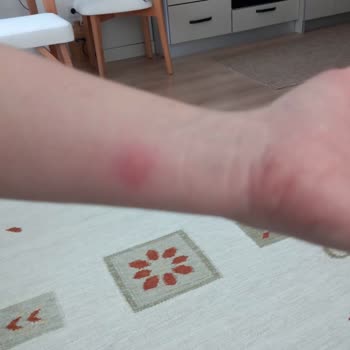 Mondi Home Yatak Takımında Tahtakurusu Ve Sağlık Riski