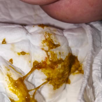 Aptamil Pronutra 1 Mamasının Aşırı Gaz Ve Sağlık Sorunları Nedeniyle Tazmin Talebi