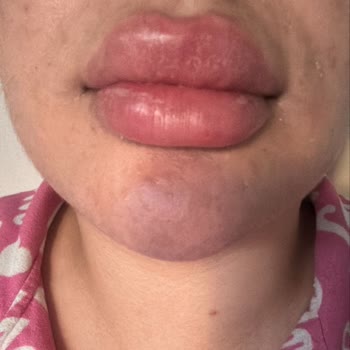 Time Estetik’te Dudak Dolgusu Sonrası Sertleşme Ve İade Reddi