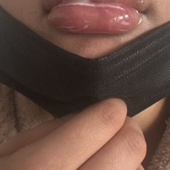 Time Estetik’te Dudak Dolgusu Sonrası Sertleşme Ve İade Reddi