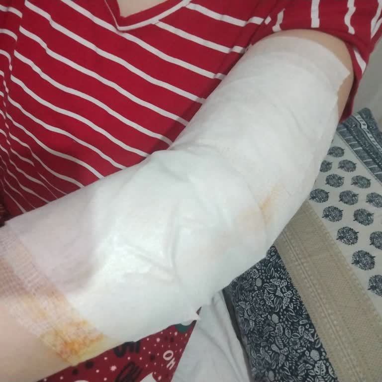 Patlamaya Garanti Söylenen Arçelik Pişiricinin İki Kez Patlaması Ve Eşime Gelen Ağır Yanıklar