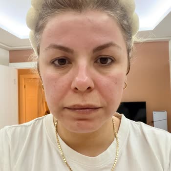 Rossmann’da Aldığım Isana Aktiv Kohle Ürünü Ciddi Alerjik Reaksiyon Ve İade Talebi