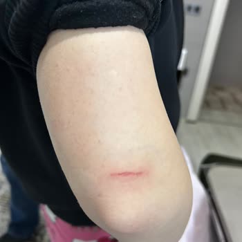 Sağlığıma Tehdit Eden Braun IPL Yanık Ve Eritilen Plastik Sorunu