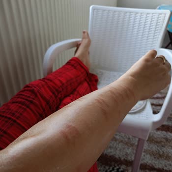 Sağlığımı Tehlikeye Attıran IPL Cihazının Yanması Ve Tam Geri Ödeme Talebi