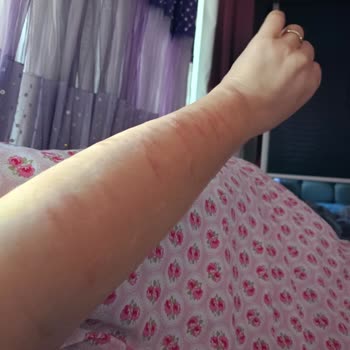 Sağlığımı Tehlikeye Attıran IPL Cihazının Yanması Ve Tam Geri Ödeme Talebi