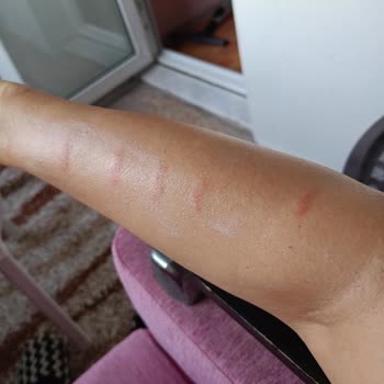 Sağlığımı Tehlikeye Attıran IPL Cihazının Yanması Ve Tam Geri Ödeme Talebi