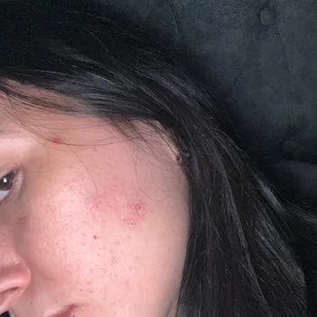 Ciltte Yara Ve Sivilce Açan Keçi Sütü Losyonuna Tepkim