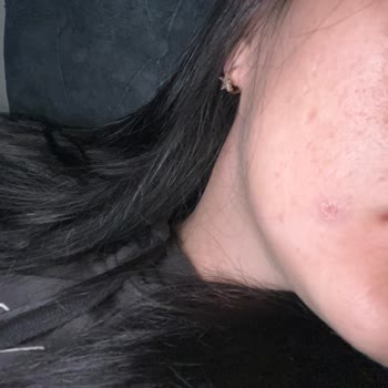 Ciltte Yara Ve Sivilce Açan Keçi Sütü Losyonuna Tepkim