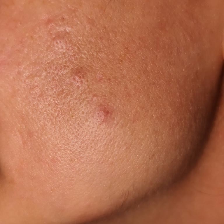 Watsons Güneş Kremi Kullanımından Sonra Yüzümde Akne Ve Kızarıklık Yaşadım