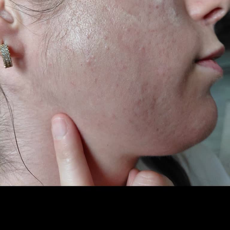 Sebium Sensitive Kreminde Ciltte Emilmeme Ve Kapalı Komedon Sorunu