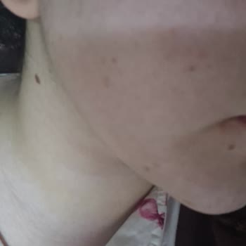 Maruderm Yüz Kreminde Şiddetli Kızarıklık Ve Tahriş Nedeniyle Ücret İadesi Talebi