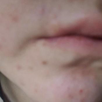 Maruderm Yüz Kreminde Şiddetli Kızarıklık Ve Tahriş Nedeniyle Ücret İadesi Talebi