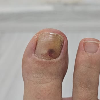 Mizuno Koşu Ayakkabısının Kısa Sürede Ayak Parmağını Yaralaması Ve İade Talebi