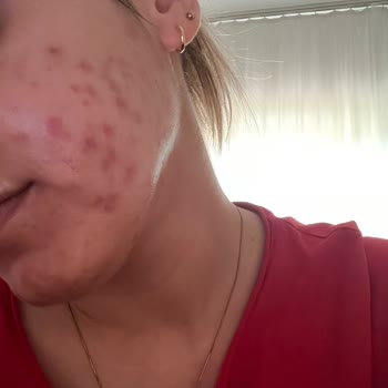 Deniz Karbeyaz Güzellik Koçu Leke Tedavisi Cildi Kötüleştirdi ve Yanıltıcı Ürün Satışı Yaptı