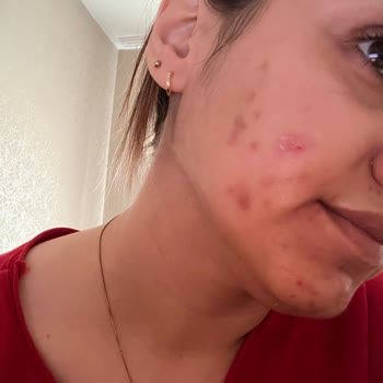 Deniz Karbeyaz Güzellik Koçu Leke Tedavisi Cildi Kötüleştirdi ve Yanıltıcı Ürün Satışı Yaptı