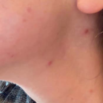 Sahte Kozvit Ürünleri Nedeniyle Cilt Reaksiyonu Ve Yanıtsız Şikayet