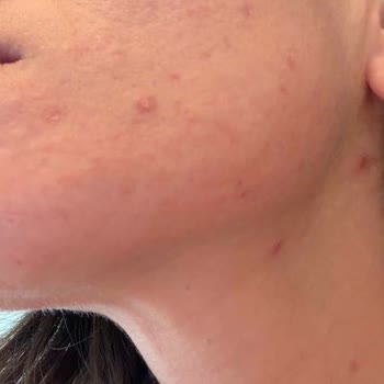 Sahte Kozvit Ürünleri Nedeniyle Cilt Reaksiyonu Ve Yanıtsız Şikayet