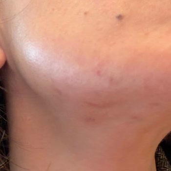 Sahte Kozvit Ürünleri Nedeniyle Cilt Reaksiyonu Ve Yanıtsız Şikayet