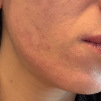 Sahte Kozvit Ürünleri Nedeniyle Cilt Reaksiyonu Ve Yanıtsız Şikayet