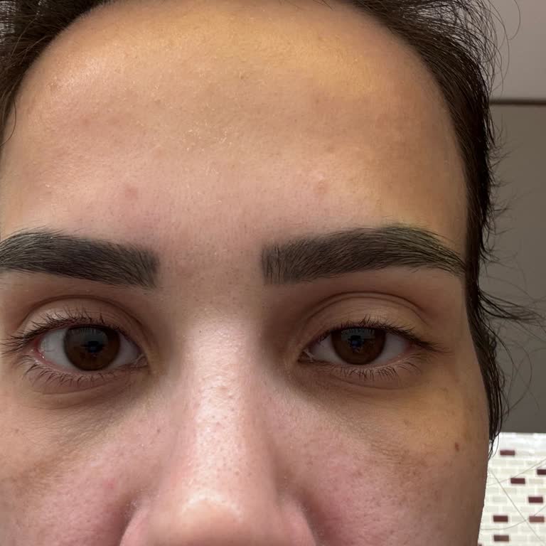 Botoks İşlemi Sonrası Göz Kapağı Düşmesi Ve Cevapsız Klinik Tutumu