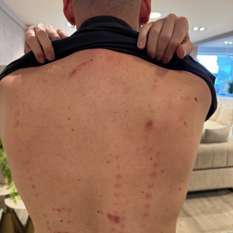 Lazer Epilasyonunda Yanık Ve Küfür, Tam İade Talebi