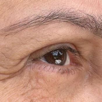 Üst Göz Kapak Ameliyatı Sonrası Ciddi Memnuniyetsizlik Ve 100 Bin TL İade Talebi