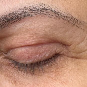 Üst Göz Kapak Ameliyatı Sonrası Ciddi Memnuniyetsizlik Ve 100 Bin TL İade Talebi