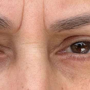 Üst Göz Kapak Ameliyatı Sonrası Ciddi Memnuniyetsizlik Ve 100 Bin TL İade Talebi