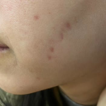 Defa Life Hastanesi Dermatoloji'de Zoretanin Ve Lazer Tedavileri Nedeniyle Kalıcı Cilt Hasarı