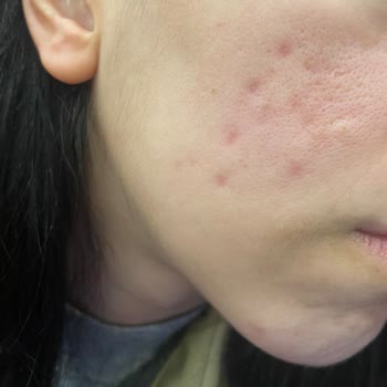 Defa Life Hastanesi Dermatoloji'de Zoretanin Ve Lazer Tedavileri Nedeniyle Kalıcı Cilt Hasarı