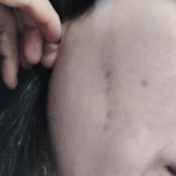 Defa Life Hastanesi Dermatoloji'de Zoretanin Ve Lazer Tedavileri Nedeniyle Kalıcı Cilt Hasarı