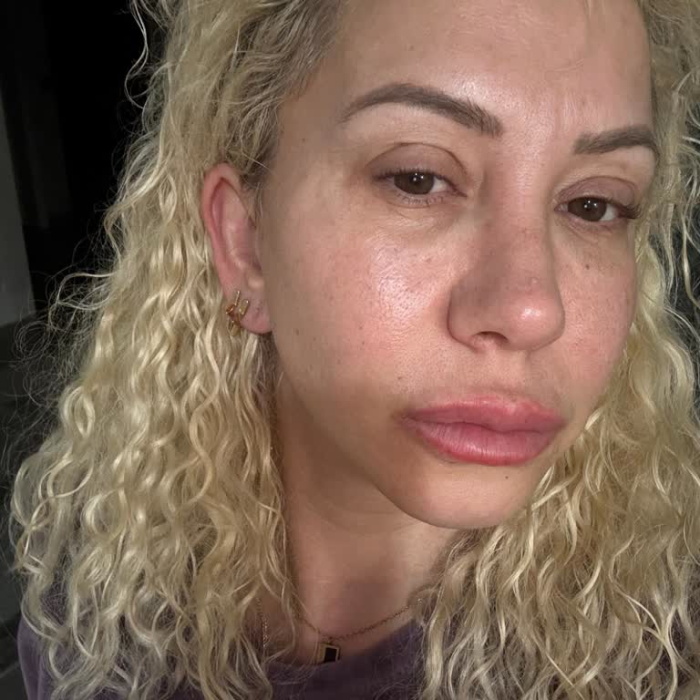Yüz Asimetrisi Ve Sürekli Göz Ağrısı Nedeniyle İade Talebi