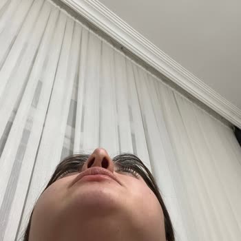 Rhinoplasti Sonrası Asimetrik Sonuç Ve Doktorun İlgisizliği