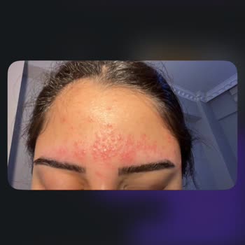 Make Up Gizem'de Alerjik Reaksiyon Ve Kullanılamayan Seanslar Nedeniyle İade Talebi