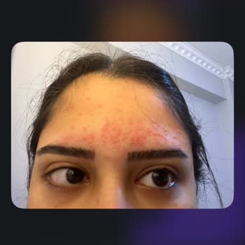 Make Up Gizem'de Alerjik Reaksiyon Ve Kullanılamayan Seanslar Nedeniyle İade Talebi