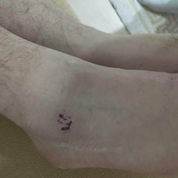 Peros Tablet Deterjanı Nedeniyle Şiddetli Alerjik Reaksiyon Ve İade Talebi