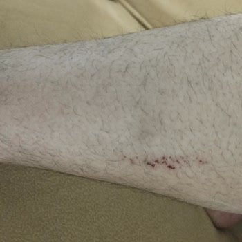 Peros Tablet Deterjanı Nedeniyle Şiddetli Alerjik Reaksiyon Ve İade Talebi