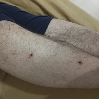 Peros Tablet Deterjanı Nedeniyle Şiddetli Alerjik Reaksiyon Ve İade Talebi